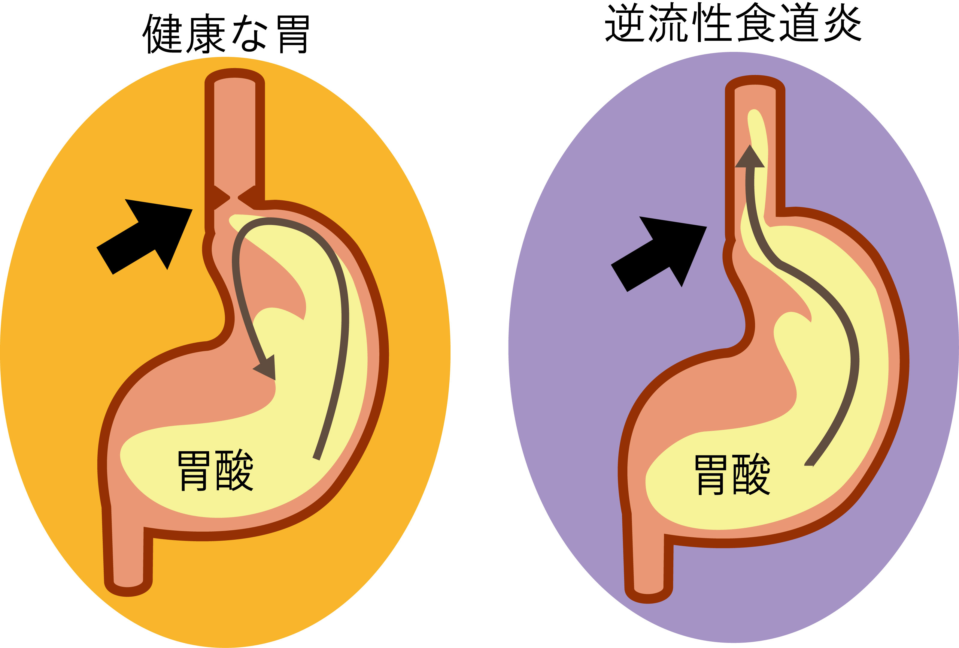 食後 胃 の 不 快感